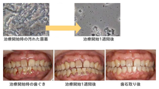 治療開始から開始１週間後の菌の様子と口腔内