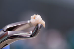 歯を失ったら…　　その弊害と治療方法について
