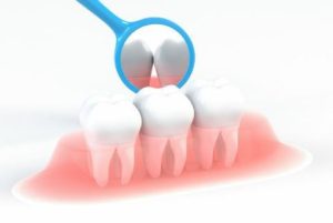 虫歯と歯周病は感染症