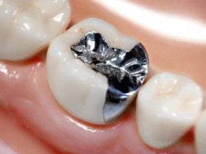 銀歯にはリスクがある？！～銀歯のメリット・デメリット～